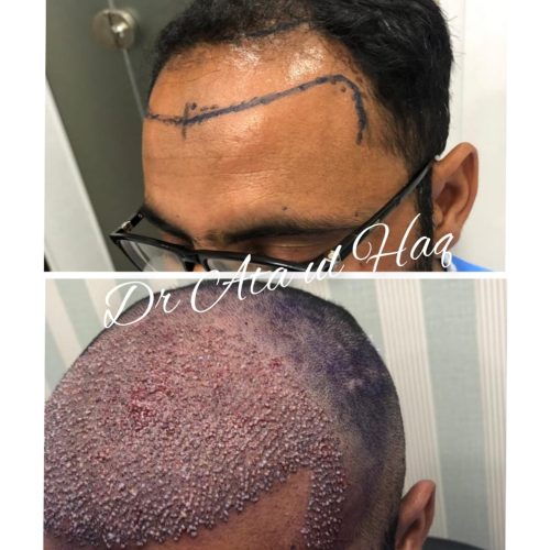 Hair Transplants (4)