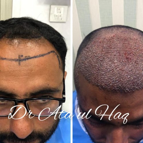 Hair Transplants (5)