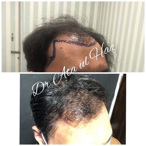 Hair Transplants (6)