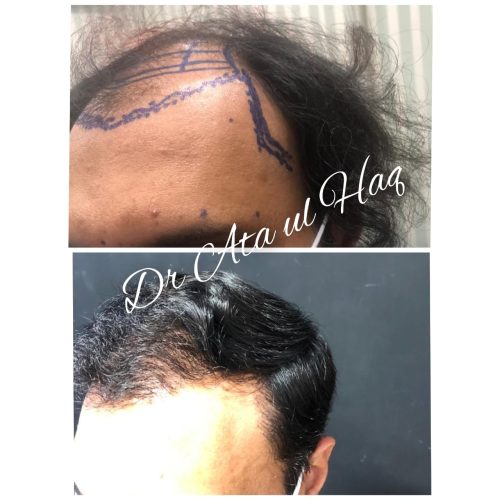 Hair Transplants (7)