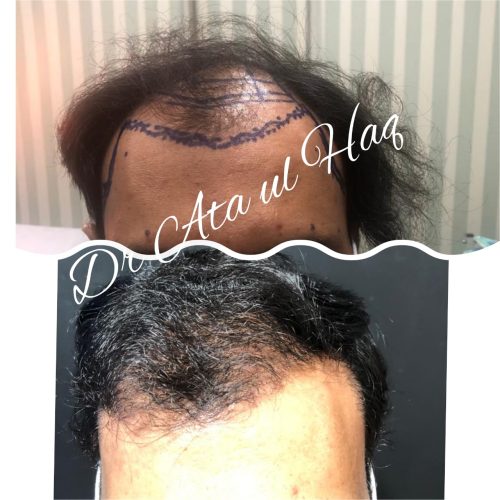 Hair Transplants (8)