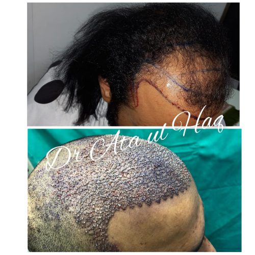 Hair Transplants (9)