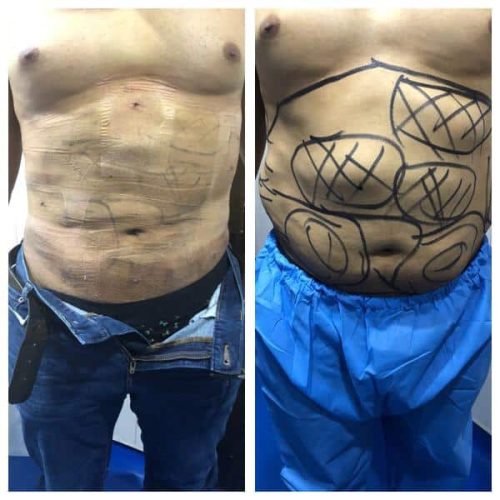liposuction-surgery
