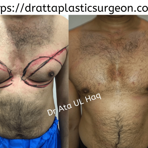 Breast-augmentation-in-lahore