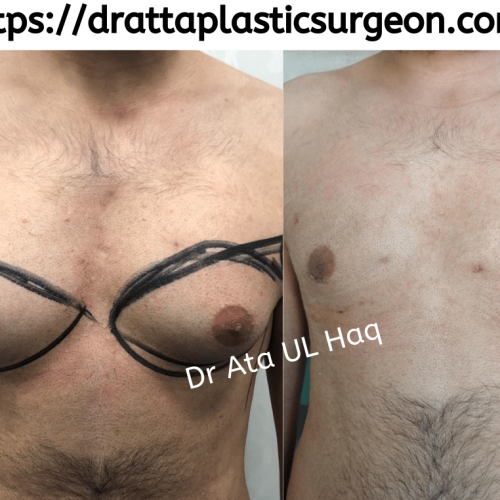 Breast-augmentation-in-lahore