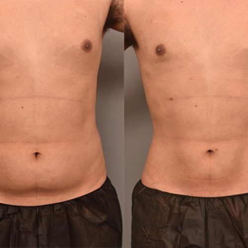 liposuction-surgery