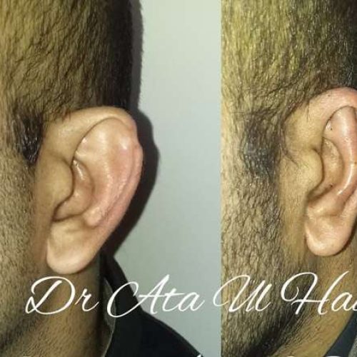 otoplasty in lahore