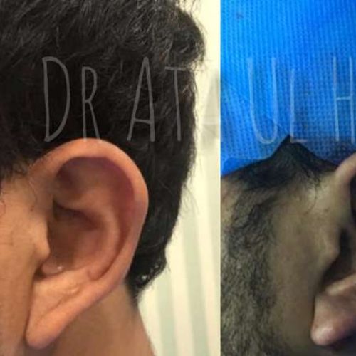 otoplasty-in-lahore2