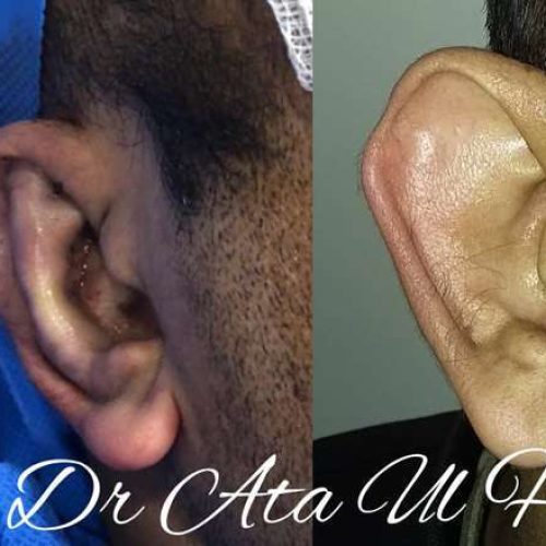 otoplasty-in-lahore3