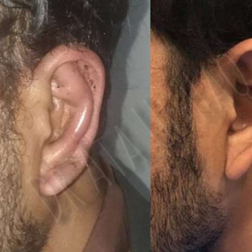 otoplasty-in-lahore4