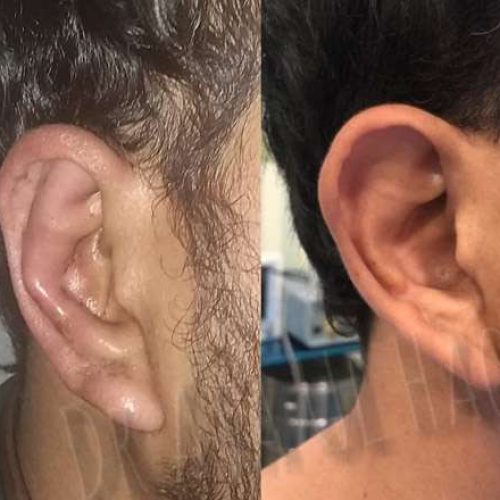 otoplasty-in-lahore5