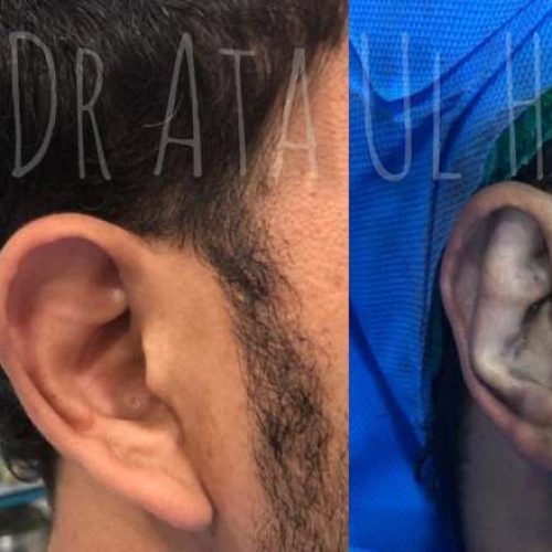 otoplasty-in-lahore6