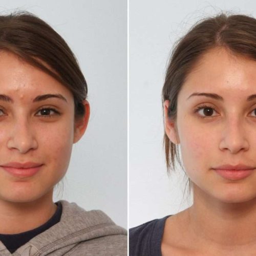 At 24, this young woman from Conroe was frustrated with the shape of her ears which had kept her from wearing her hair up most of her life. Dr. Vitenas performed a bilateral otoplasty to reshape the cartilage and increase the anthelical fold inside the rim of the ear. Today she has a renewed sense of confidence in her appearance, even in a ponytail.