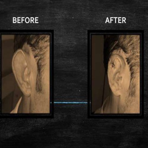 otoplasty1