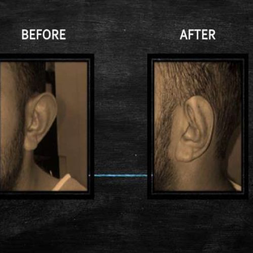 otoplasty3